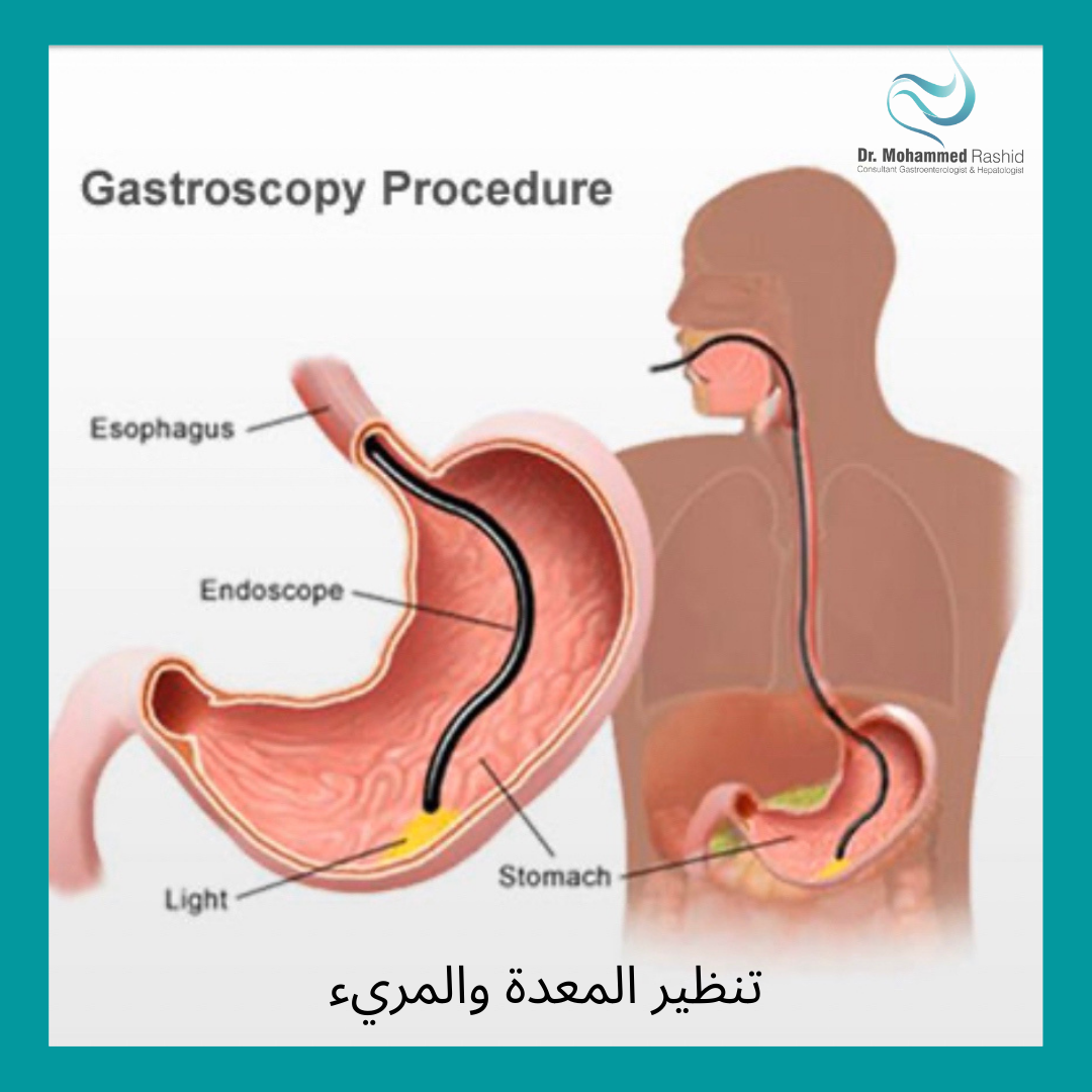 Биопсия пищевода. Фиброгастроскопия язва желудка. Эндоскопическое исследование слизистой оболочки пищевода желудка. Язва желудка ФГДС эндоскопия.